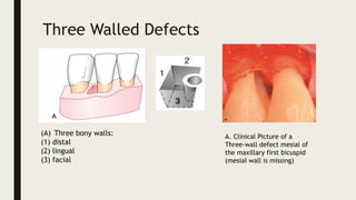 Three Walled Defects
A. Clinical Picture of a
Three-wall defect mesial of
the maxillary first bicuspid
(mesial wall is missing)
(A) Three bony walls:
(1) distal
(2) lingual
(3) facial
 