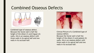 Combined Osseous Defects
Combined type of osseous defect.
Because the facial wall is half the
height of the distal (1) and lingual (2)
walls, this is an osseous defect with
three walls in its apical half and two
walls in its occlusal half.
Clinical Picture of a Combined type of
osseous defect.
Because the facial wall is half the
height of the distal (1) and palatal (2)
walls, this is an osseous defect with
three walls in its apical half and two
walls in its occlusal half.
 
