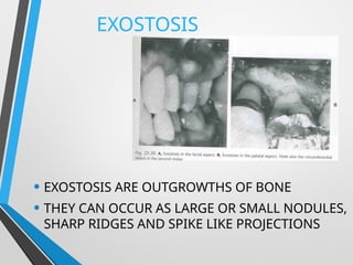 Exostis BONE LOSS AND PATTERNS OF BONE DESTRUCTION.pptx