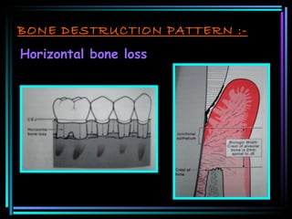BONE DESTRUCTION PATTERN :- Horizontal bone loss 