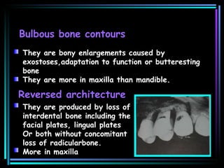 Bulbous bone contours They are bony enlargements caused by exostoses,adaptation to function or butteresting bone They are more in maxilla than mandible. Reversed architecture They are produced by loss of interdental bone including the facial plates, lingual plates  Or both without concomitant loss of radicularbone. More in maxilla  
