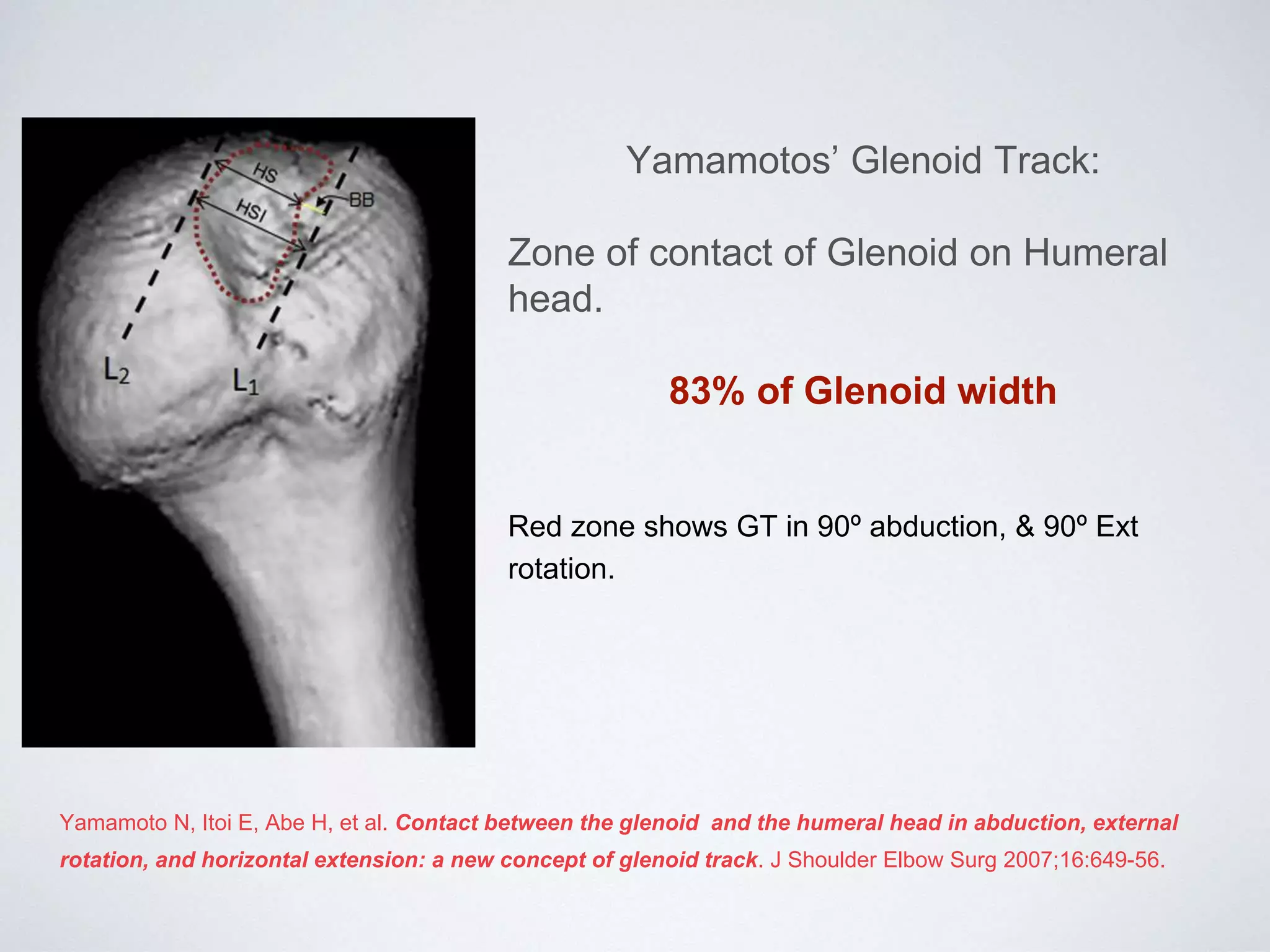 Recurrent Injuries Recurrent Anterior instability of Shoulder with bone loss | PPT