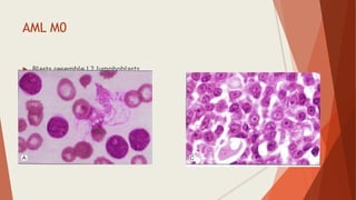 AML M0
 Blasts resemble L2 lymphoblasts
 blasts are MPO negative
 
