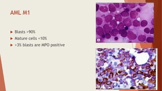 AML M1
 Blasts >90%
 Mature cells <10%
 >3% blasts are MPO positive
 