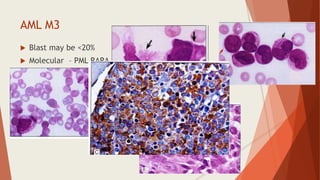 AML M3
 Blast may be <20%
 Molecular – PML RARA /t(15;17)
 2 types – hypergranular variant, microgranular variant
 