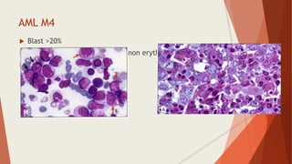 AML M4
 Blast >20%
 Monocytic component> 20% of non erythroid MNCs
 Monocytes in blood>5x103 μl
 
