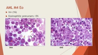 BMA BMB
AML M4 Eo
 inv (16)
 Eosinophilic precursers >5%
 