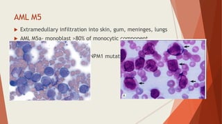 AML M5
 Extramedullary infiltration into skin, gum, meninges, lungs
 AML M5a- monoblast >80% of monocytic component
 AML M5b- monoblast <80%
 Acute monocytic leukemia- NPM1 mutation
 