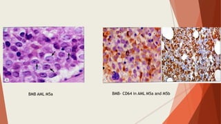 BMB AML M5a BMB- CD64 in AML M5a and M5b
 
