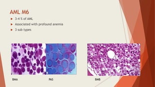 AML M6
 3-4 % of AML
 Associated with profound anemia
 3 sub types
BMA PAS BMB
 