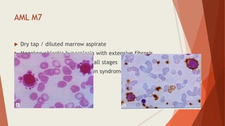 AML M7
 Dry tap / diluted marrow aspirate
 Megakaryoblastic hyperplasia with extensive fibrosis
 Megakaryocytic cells seen in all stages
 Associated with t (1;22), down syndrome
 