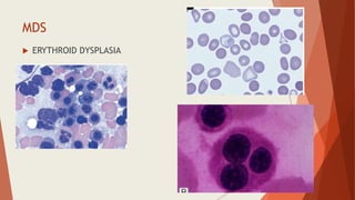 MDS
 ERYTHROID DYSPLASIA
 