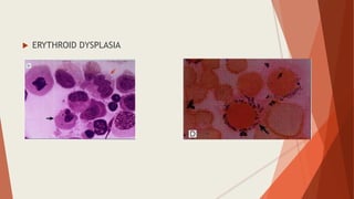  ERYTHROID DYSPLASIA
 