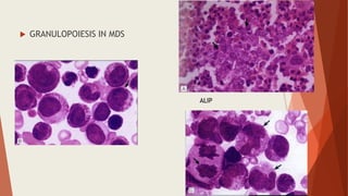  GRANULOPOIESIS IN MDS
ALIP
 