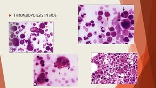  THROMBOPOIESIS IN MDS
 