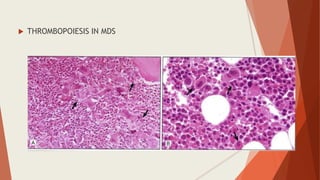  THROMBOPOIESIS IN MDS
 