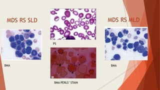 MDS RS SLD MDS RS MLD
PS
BMA PERLS’ STAIN
BMA BMA
 