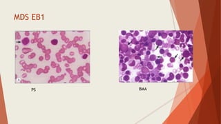 MDS EB1
PS BMA
 