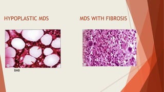 HYPOPLASTIC MDS
BMB
MDS WITH FIBROSIS
 