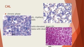 CML
 chronic phase
 PBS- TLC (30-500x103/μl), myelocytic bulge,absolute
basophilia, thrombocytosis
 NAP score (0-20)
 BM-hypercellular, M:E ratio elevated, blast<5%,
megakaryocyte hyperplasia with dwarf forms seen
BMA
 