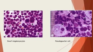 Dwarf megakaryocytes Pseudogaucher cell
 