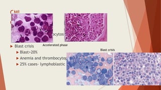 CML
 Accelerated phase
 Blasts 10-19%
 Persistent thrombocytosis or thrombocytopenia
 Basophilia >20%
 Blast crisis
 Blast>20%
 Anemia and thrombocytopenia
 25% cases- lymphoblastic
Accelerated phase
Blast crisis
 
