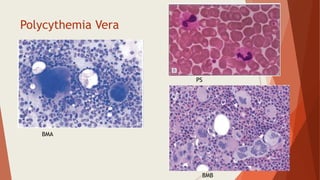 Polycythemia Vera
PS
BMA
BMB
 