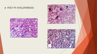  POST PV MYELOFIBROSIS
 