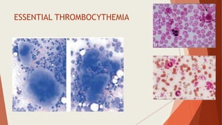 ESSENTIAL THROMBOCYTHEMIA
 