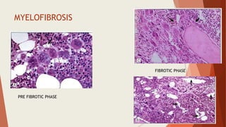 MYELOFIBROSIS
PRE FIBROTIC PHASE
FIBROTIC PHASE
 