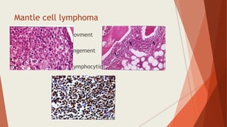 Mantle cell lymphoma
 Difffuse marrow invovment
 Paratrabecular arrangement
 Variants- blastoid, lymphocytic, pleomorphic
 