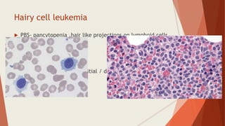 Hairy cell leukemia
 PBS- pancytopenia ,hair like projections on lymphoid cells
 TRAP positive
 Splenomegaly
 BRAFV600E mutation
 BM- dry tap, focal/ interstitial / diffuse replacement of
marrow by hairy cells
 