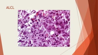 ALCL
 