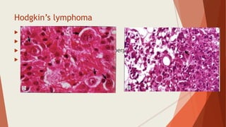 Hodgkin’s lymphoma
 Bm involvement – stage IV
 Rarely involves BM
 BM- hyper cellular due to myeloid hyperplasia
 RS cells
 