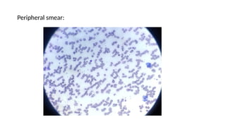 Peripheral smear:
 
