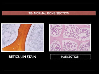 TB- NORMAL BONE SECTION
 