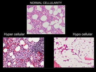 NORMAL CELLULARITY
Hyper cellular Hypo cellular
 