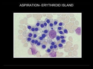 ASPIRATION- ERYTHROID ISLAND
 