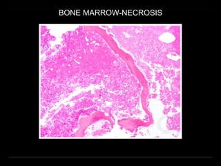 BONE MARROW-NECROSIS
 