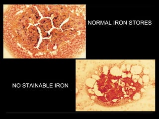 NORMAL IRON STORES
NO STAINABLE IRON
 