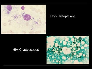 HIV- Histoplasma
HIV-Cryptoccocus
 