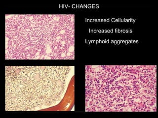 HIV- CHANGES
Increased Cellularity
Increased fibrosis
Lymphoid aggregates
 