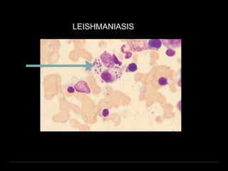 LEISHMANIASIS
 