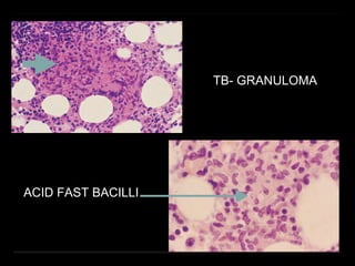 TB- GRANULOMA
ACID FAST BACILLI
 