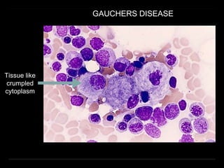 GAUCHERS DISEASE
Tissue like
crumpled
cytoplasm
 
