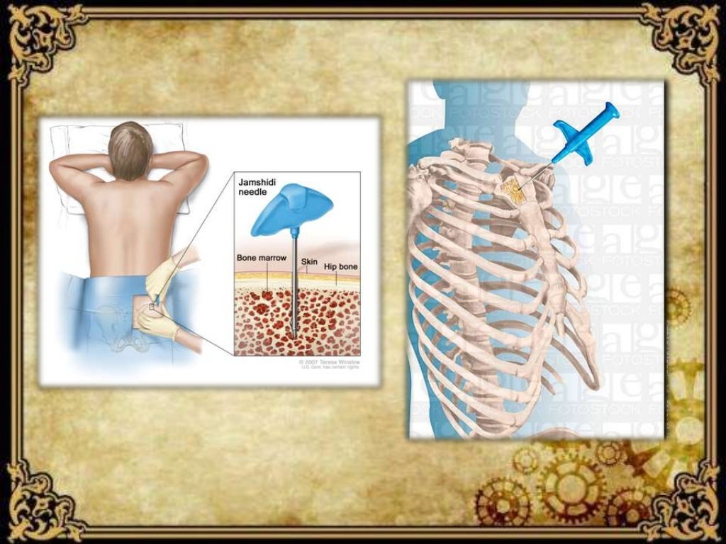 Bone marrow aspiration Bone marrow aspiration