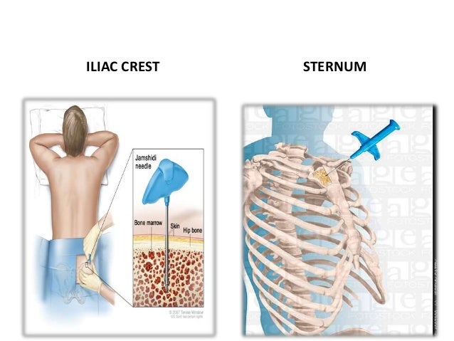 bone-marrow-aspiration