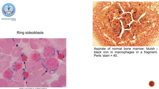 Aspirate of normal bone marrow: bluish -
black iron in macrophages in a fragment.
Perls ’stain × 40.
Ring sideoblasts
 