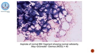 Aspirate of normal BM: fragment showing normal cellularity.
May–Grünwald– Giemsa (MGG) × 40
.
 
