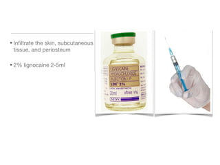 • Infiltrate the skin, subcutaneous
tissue, and periosteum
• 2% lignocaine 2-5ml
 
